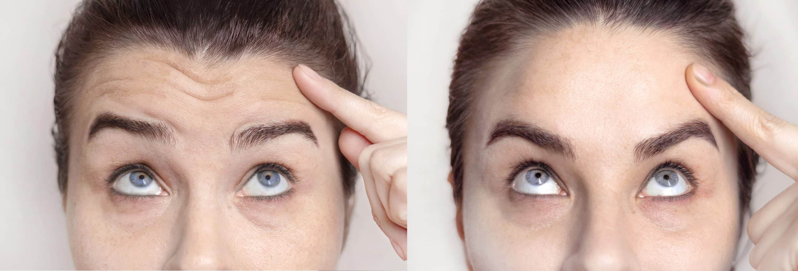 Collage with portraits Caucasian woman with wrinkles on the forehead and between her nose and portrait after visiting a beautician. Botox injections, dysport. Folds on the skin. Close up